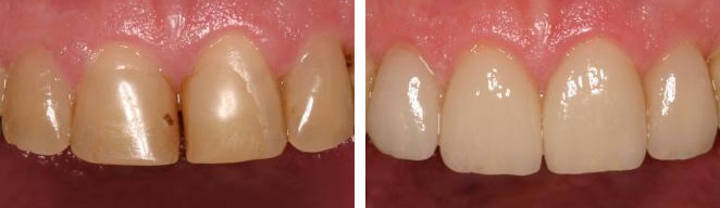 CEREC Before and After Case #1
