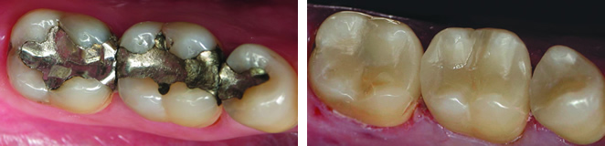 CEREC Before and After Case #1