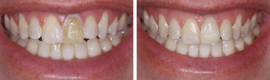 Porcelain Crowns Before and After