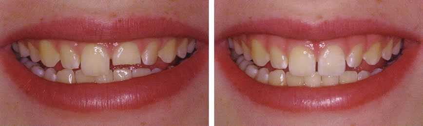 Before and After Dental Bonding Photo