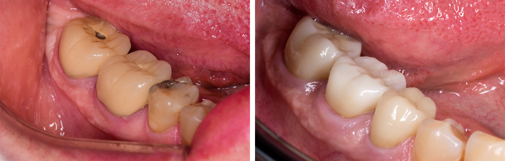 Before and After Ceramic Crowns Photo