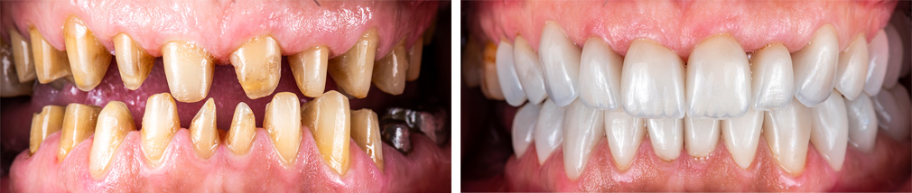 Before and After Crowns and Veneers Photo