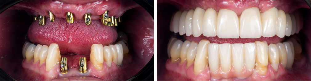 Before and After Implants and Crowns Photo