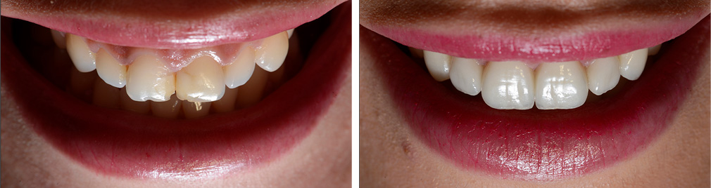 Before and After Smile Design Treatment Photo
